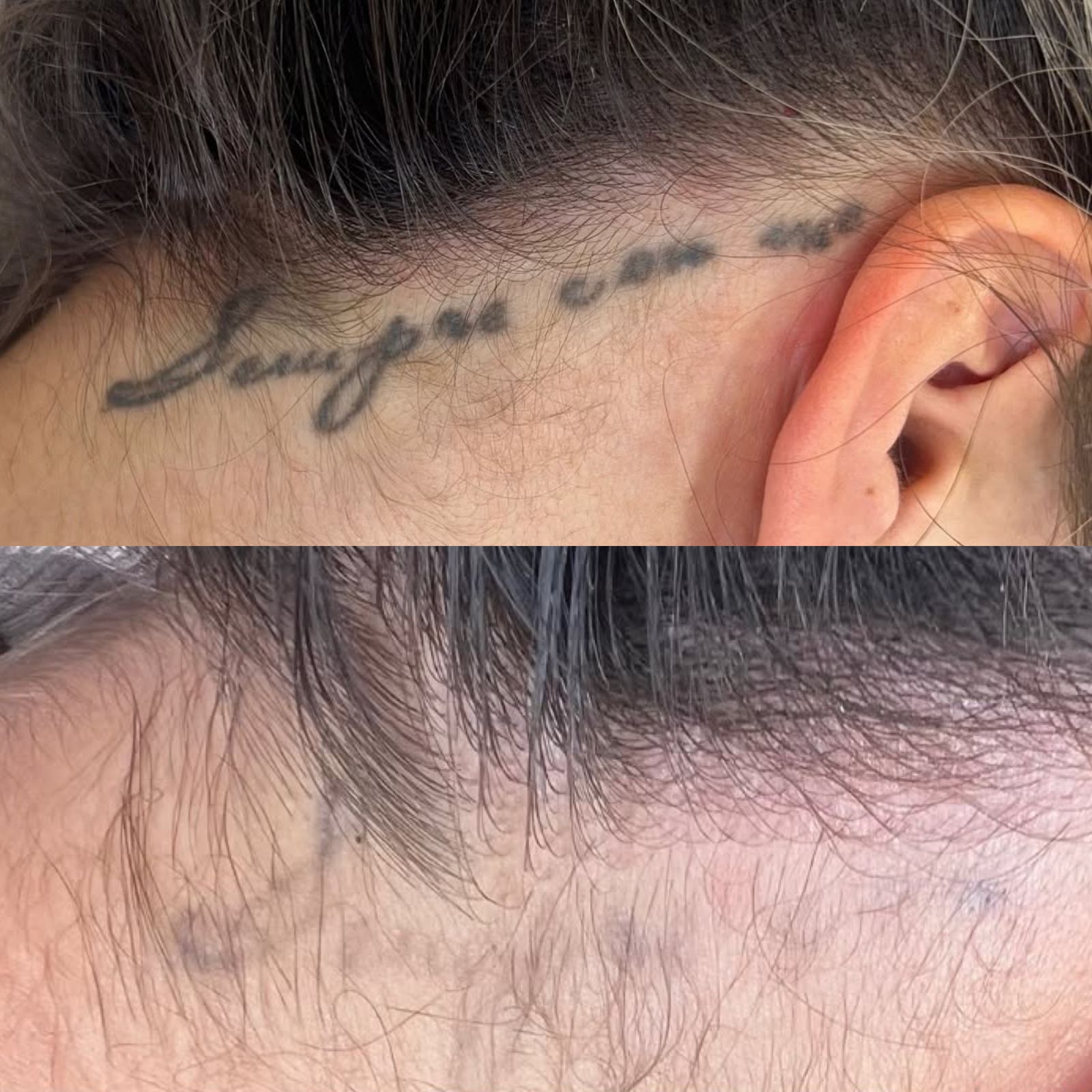 Resultado de remoção a laser